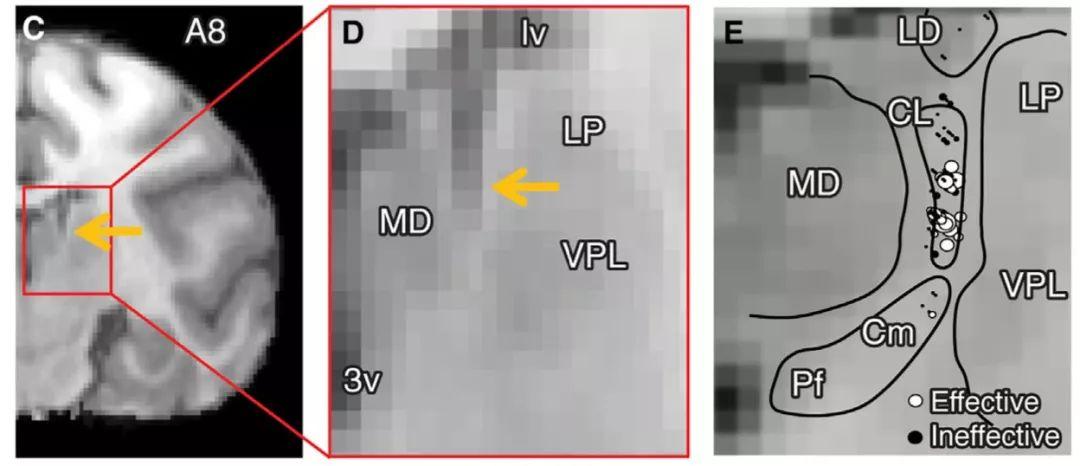 大脑深处丘脑的“意识开关”？
